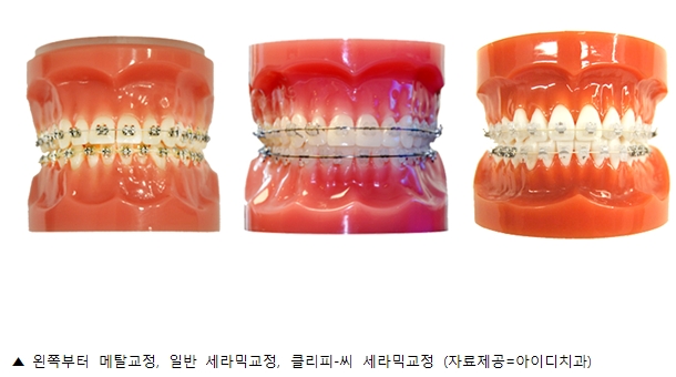 치아교정, 트렌드에 민감하다면 ‘세라믹교정’이 정답!