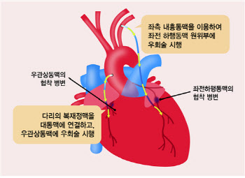 꺼져가는 심장에 새 활로 열어주는 관상동맥 우회술