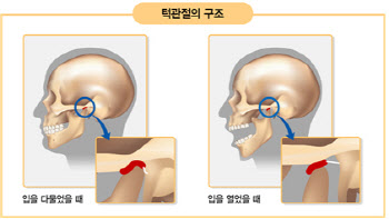 입 벌릴 때마다 딱딱 소리 나고 아프면 턱관절장애 의심해 봐야