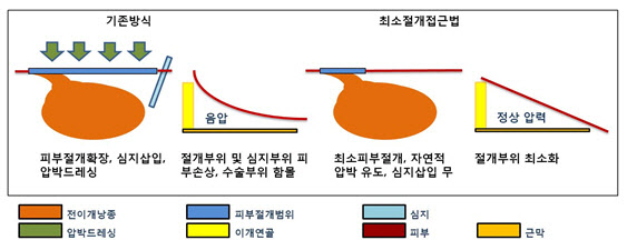 한림대춘천성심병원, 전이개낭종 최소절개접근법 개발