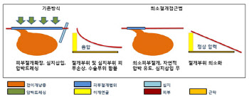 한림대춘천성심병원, 전이개낭종 최소절개접근법 개발