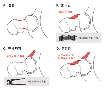 찌르는 듯한 사타구니 통증···고관절충돌증후군에 ‘관절경수술’ 효과