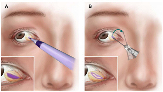 레이저를 이용한 새로운 결막낭종 제거술 개발