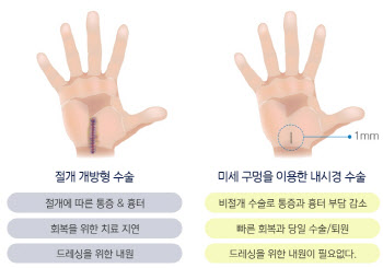 화이트칼라의 병, '손목터널증후군'에 대한 오해와 진실