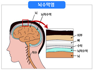 고열, 오한, 두통 등 감기 증상과 비슷한 '뇌수막염', 항생제 치료 필수