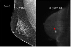 조영제 없이도 숨어있는 유방암 찾아낸다
