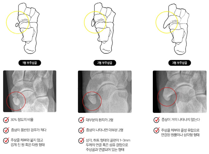 청소년기의 발목 통증, 부주상골증후군을 의심해봐야