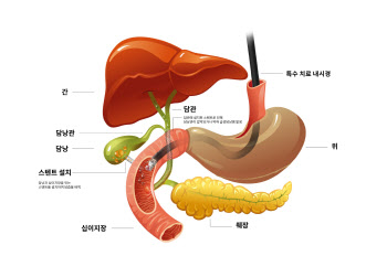 동탄성심병원, 담낭과 십이지장 잇는 최고난이도 내시경치료 성공