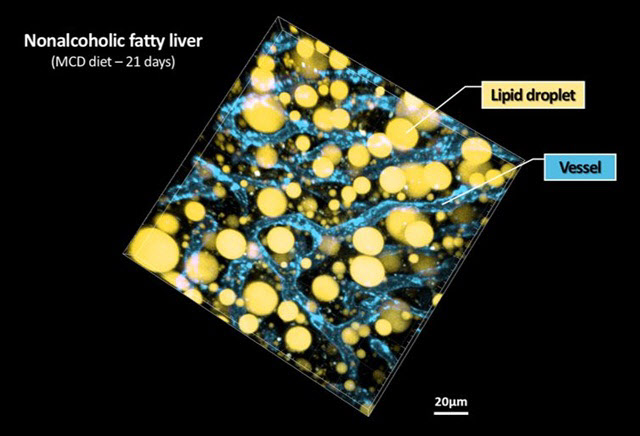 비알콜성 지방간 진행 과정 3차원 영상으로 촬영 성공