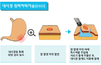 ‘위암’ 빨리 발견하면 수술 없이 내시경만으로 완치