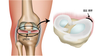 전방십자인대파열 환자, 10명 중 2~3명은 램프병변 함께 발생