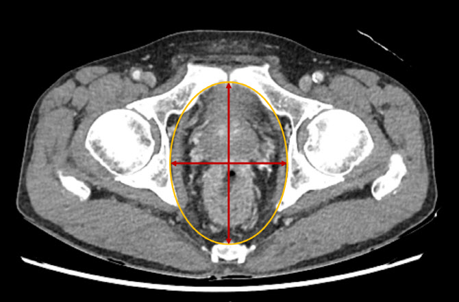 “골반 CT 촬영만으로 직장암 수술 결과 예측 가능”