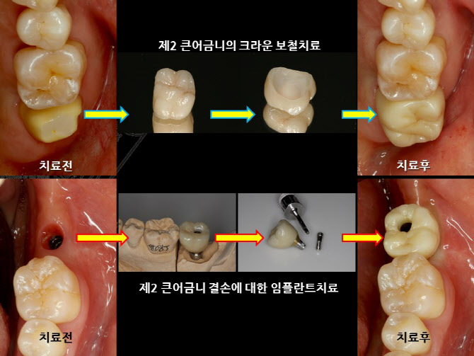 '씹고·뜯고·즐기고' ...건강한 노년 위한 최소 치아 갯수는?