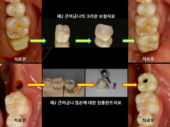 '씹고·뜯고·즐기고' ...건강한 노년 위한 최소 치아 갯수는?