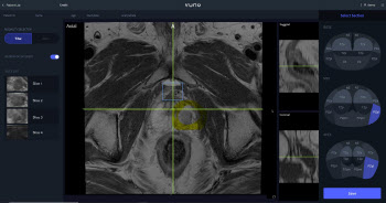 뷰노, 전립선 MR 영상 분석 SW ‘PROMISE-I’ 식약처 인증