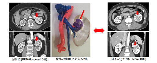 ‘3D 프린팅 신장 모형’으로 신장암 로봇수술 시간 단축한다