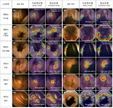 수만장의 소장 캡슐내시경 영상, 이젠 AI로 판독한다