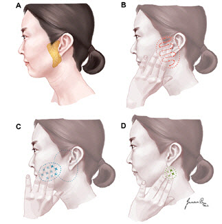 이하선 종양과 침샘암, 조기 발견을 위한 자가 검진법 개발