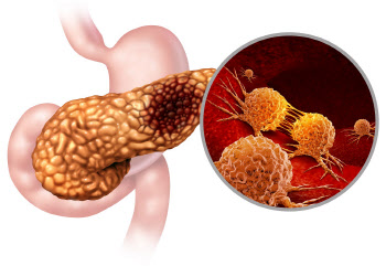췌장암 새로운 유전자 변이 찾았다