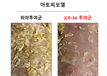 셀리버리 "iCP-NI, 美 CRO서 아토피 치료효능 입증"