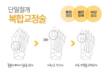 뼈를 깎는 수술은 옛말, 지금 무지외반증 수술의 키워드는 '최소 침습'