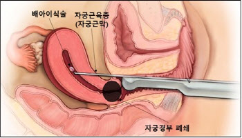 로봇수술 후 자궁 폐쇄된 환자, ‘자궁근막 통과 배아이식술’로 임신ㆍ출산 성공