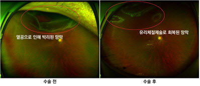눈 앞 커튼 쳐진 듯한 증상의 망막박리, 급히 안과 검사 받아야