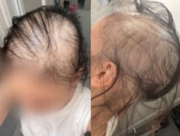 "모더나 맞고 대머리 됐다" 日여성, 2차 접종한 이유