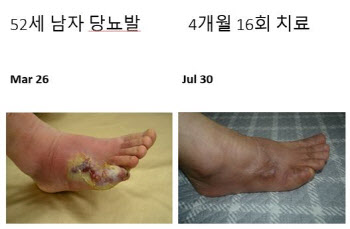 당뇨병 환자 4명 중 1명 앓는 ‘당뇨발’ 방치하다 다리 절단할수도