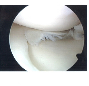 무릎 통증 부르는 '반월상 연골파열'…관절내시경으로 진단치료 동시에
