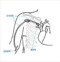상완동맥-흉곽내 홑정맥을 이용한 동정맥루 수술 성공
