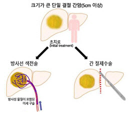 방사선 색전술, 크기가 큰 간암에서 수술만큼 효과적