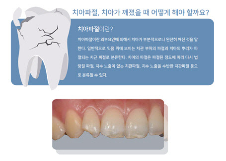 정월대보름에 부럼 깨기 조심해야...치아가 깨졌을 땐 이렇게 하세요