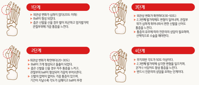 가수 출신 쇼핑몰 CEO 김준희씨가 공개한 자신의 ‘무지외반증’