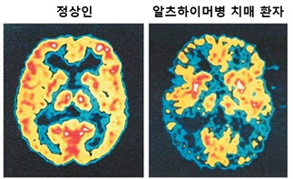 셀리버리, 치매극복연구개발 국책사업에 치매치료제 신약개발과제 선정