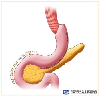 수술로 비만.당뇨병 한번에 치료...식단 등 체중 유지 사후관리까지