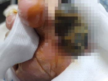 까맣게 말라비틀어진 아버지 발가락… 원주 요양병원서 무슨 일?