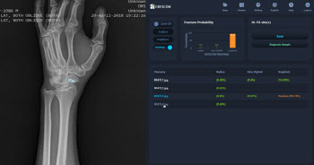 크레스콤, 인공지능 손목골절 자동검출 솔루션 식약처 허가 취득