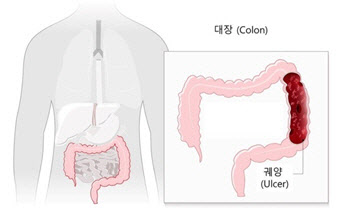 ‘궤양성대장염’ 환자 10년새 3.8배나 급증