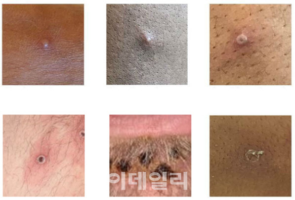 [속보]'원숭이두창' 내일부터 법정감염병 2급 지정