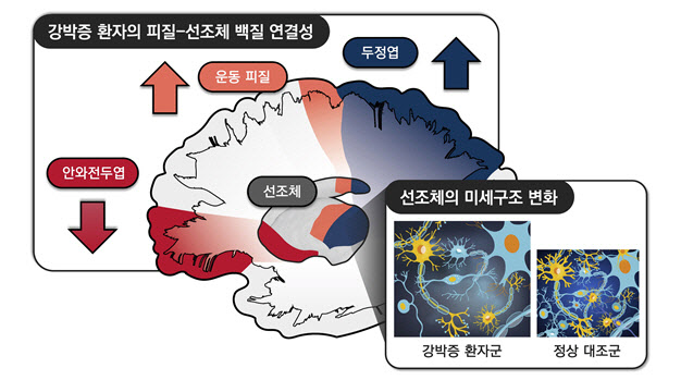 강박증, 뇌 속 선조체 회로가 원인?