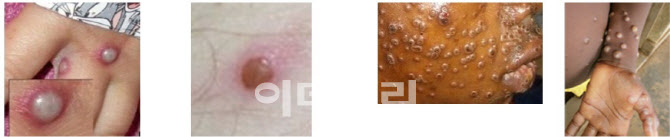 [속보]"원숭이두창 환자와 같은 비행기 승객 밀접접촉 아냐"