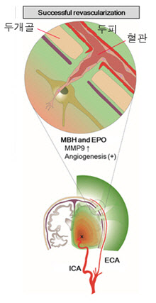 막힌 뇌혈관, 뚫을 수 없다면 새로운 혈관을 만든다