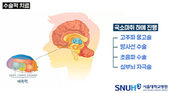 손떨림 즉 수전증의 가장 효과적인 치료법은?