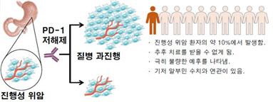 위암 환자에서 면역관문억제제에 의한 급격한 질병 악화 현상 규명