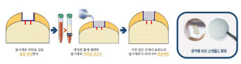 손상된 발목 연골, 줄기세포 치료가 도움