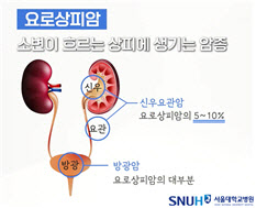 미지의 암,‘신우요관암’, 발견되면 늦어 예방이 매우 중요