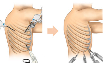 수술 후 갈비뼈 ‘찌릿’ ‘콕콕’... 늑간신경통 없는 폐암 로봇 수술법 개발
