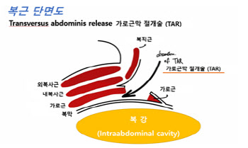 치료 어려운 위치의 복벽탈장, 로봇수술 첫 성공