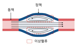 혈관 협착 막는 투석혈관 기기 개발